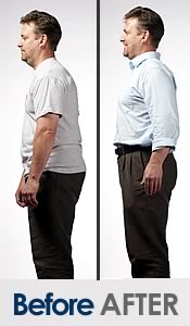 Before And After Posture Corrector