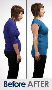 Before After Posture Correction Women