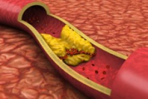 Using Light and Sound to Detect Artery Blockage. Scientists have developed a 3-D imaging method that uses both light and sound waves to spot fatty deposits within tissues. The technique holds promise for noninvasively detecting atherosclerosis and possibly other disorders that involve fatty buildup.