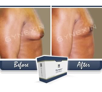 gynexin-before-after