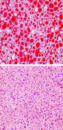 Normal mice store fat (in red) in the liver when fed a high-fat diet (top). Parkin-deficient mice fail to store fat normally (bottom). Image by Kim et al., courtesy of the Journal of Clinical Investigation.