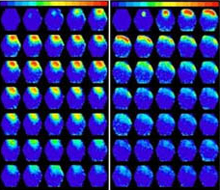 After electrical stimulation, there is a prolonged, broader spread of activity (yellow and red areas) in mouse brain tissue containing a glioma (left) compared to normal mouse brain tissue (right). Adjacent frames are 1.8 milliseconds apart.Courtesy of Dr. Harald Sontheimer, University of Alabama Birmingham.