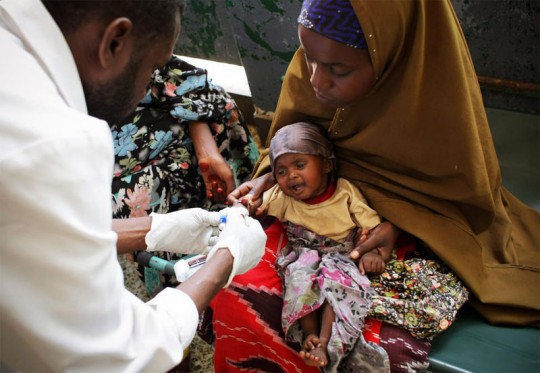 Malnourished child receives medical assistance in Mogadishu, Somalia