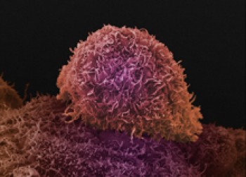 A prostate cancer cell. Image by Anne Weston. All rights reserved by Wellcome Images.